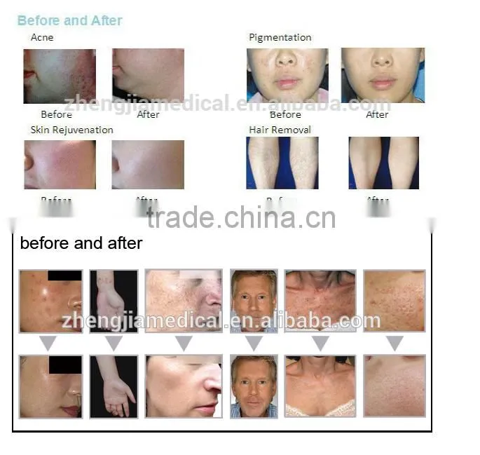facial skin lifting and tightening fractional co2 laser/vaginal tightening co2 laser machine