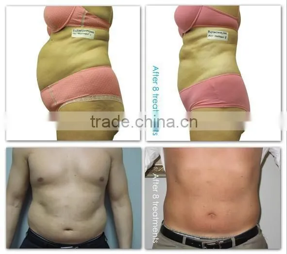 (CE-Certification)New arrival Fractional co2 laser