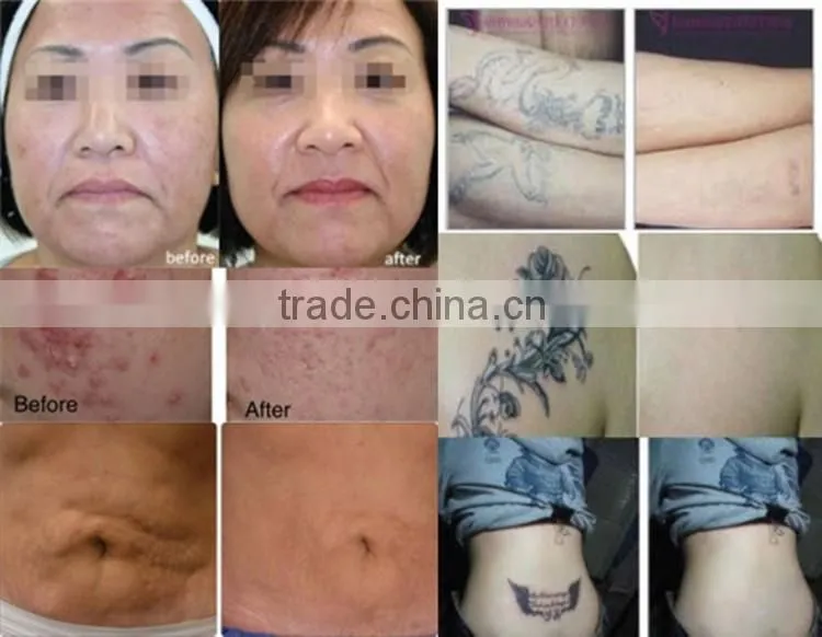 Portable Q Switched ND YAG Laser/Tattoo removal machine