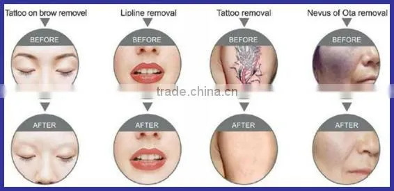 Salon use ! 3 in 1 rf ipl laser for hair removal and skin care and tatoo removal