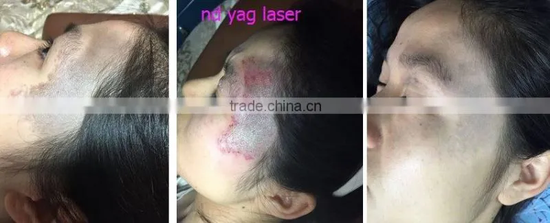 Alibaba in spanish wholesale tattoo removal yag laser q switched nd yag laser/tattoo aesthetic laser