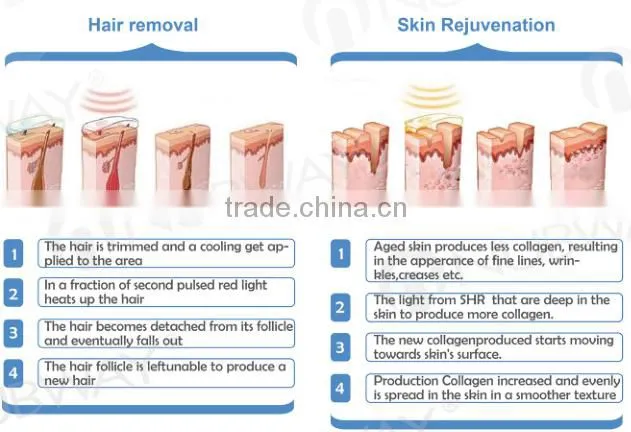 2015 newest IPL SHR beauty equipment Elos Laser Hair Removal Machine / SHR IPL