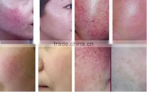 acne spider vein removal machine / high power spider vein removal machine / vascular vein spider vein removal rf