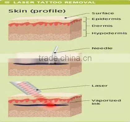 EO Q switch ND: YAG LASER1