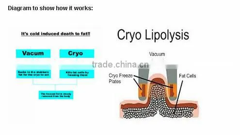 Fat Cavitation Device For Home/Weight Loss Machine/RF--Pro Cryolipo