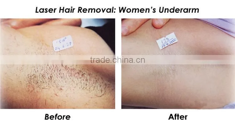 Professional lightsheer diode laser hair removal 808 nm laser diode portable