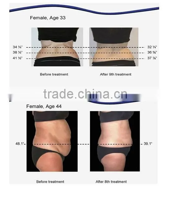 Lipo laser slimming machine