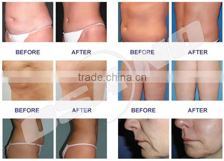 China Osano productos de belleza vaser liposuction machine