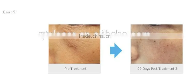 Hot product!! Meso Guns for non- surgical skin careness with multiple micro needles