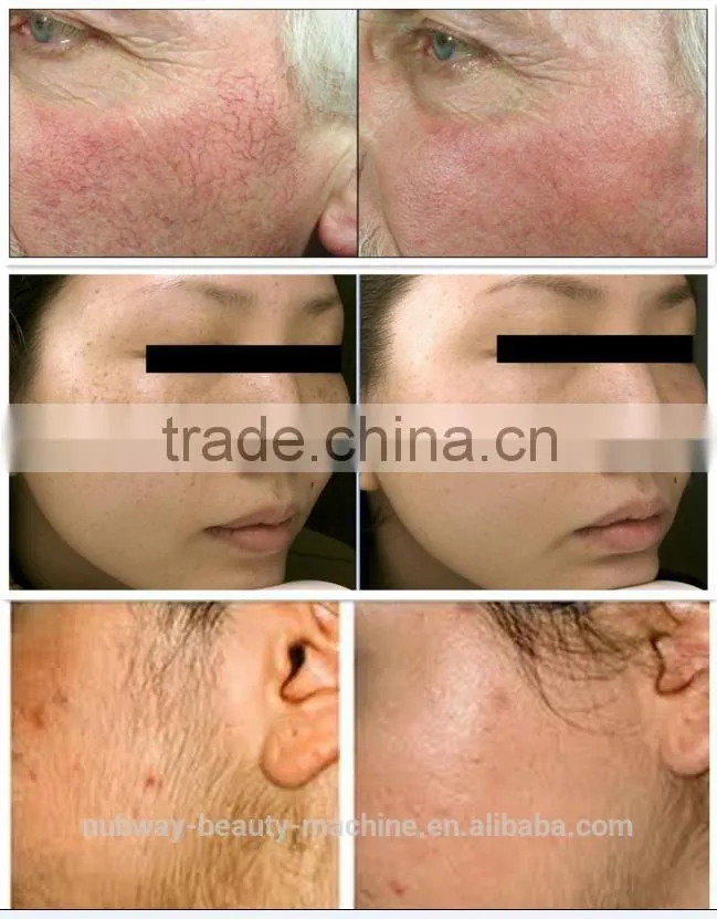 Mini Home Use Hair Removal Portable IPL Photo Facial