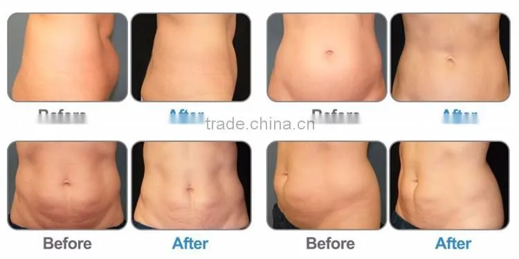 OSANO mitsubishi lipo laser slimming machine