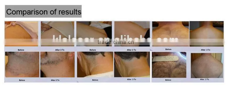 2015 Super cooling diode laser hair removal 808nm diode laser machine