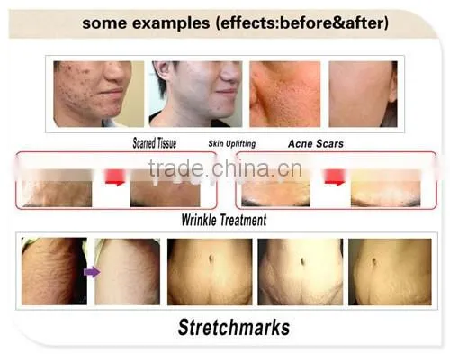 Derma Roller Micro Needle Therapy Skin Care Recovery Luxury Micro Needle Therapy Derma Roller Titanium Needles Anti-Ageing