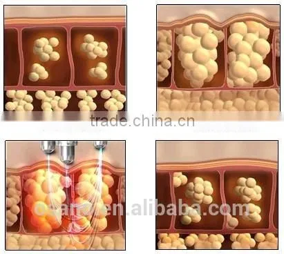 Ultrasonic Cavitation Beauty Machine RF Skin Tightening Face Lifting System