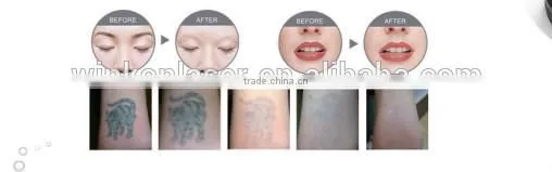 new laser for tattoo removal/ rejuvi tattoo removal