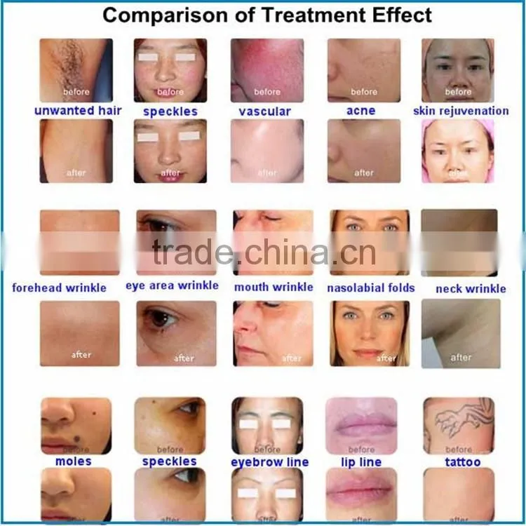 2016 home led beauty machine home laser skin wrinkle removal