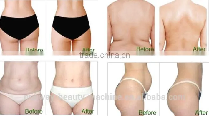 CE Certification Vacuum Portable Cryolipolysis Slim Sonic Cellulite Reduction Machine