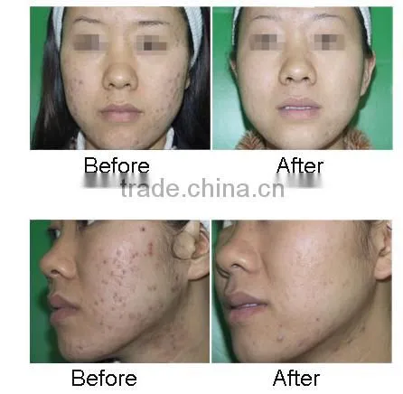 protable jet peel water oxygen skin rejuvenation machine