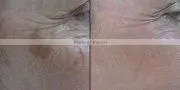 Newest !!! luxury fractional co2 laser acne scar removal