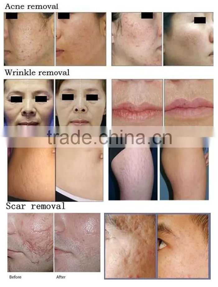 40W Fractional CO2 Laser Acne Scar & Wrinkle Removal / Co2 Laser Surgical Product Vaginal Applicator