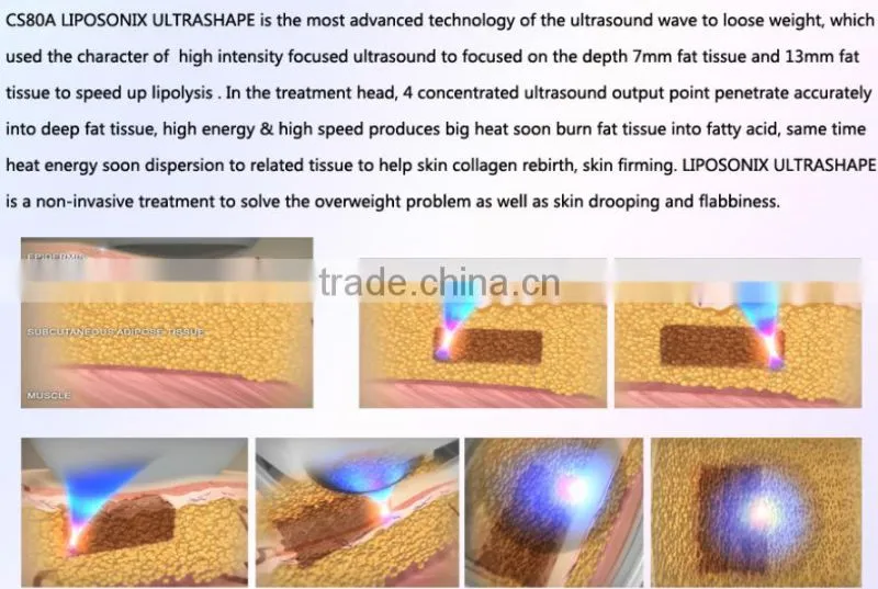 liposonix hifu/hifu system/liposonix