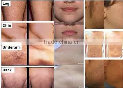 Newest generation hair removal machine Skin care opt shr machine with CE