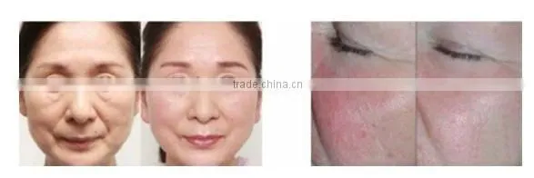 Beauty supply skin tightening thermagic rf machine