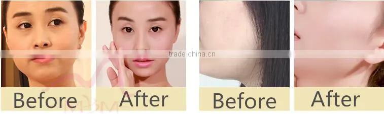 2016 Best home use RF skin tightening face lifting machine home beauty equipment