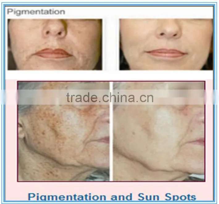 best selling products in america tattoo laser