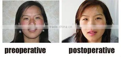 co2 laser , fractional co2 laser , beauty machine fractional co2 laser