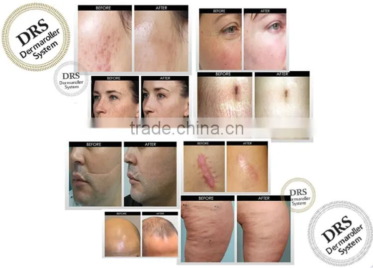 Phototherpay vibrating microneedle roller 5 in 1