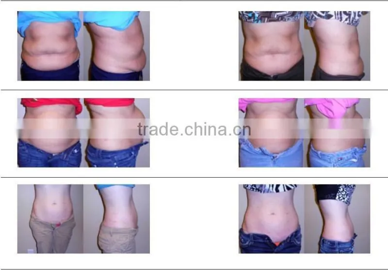laser cavitation fat system ls650