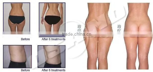 Osano lipolaser cellulite removal skin care beauty machine 650nm lipo laser belly fat removal