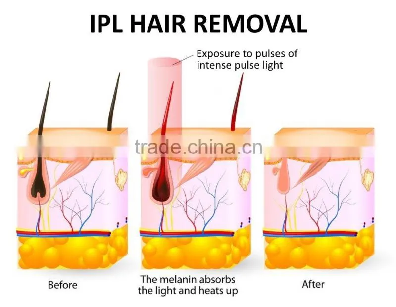 3 in 1 Newest ipl laser hair removal machines home use, portable ipl machine