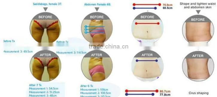 Portable Radio Frequency System Cavitation Cellulite System Ultrasonic Fat Cavitation Slimming Machine