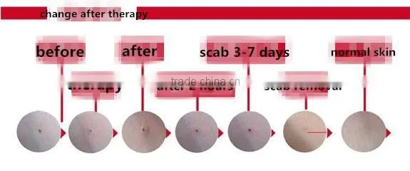 Plasma pen co2 mole removal price
