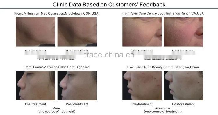 Wholesale ultrasonic skin care beauty device for salon use