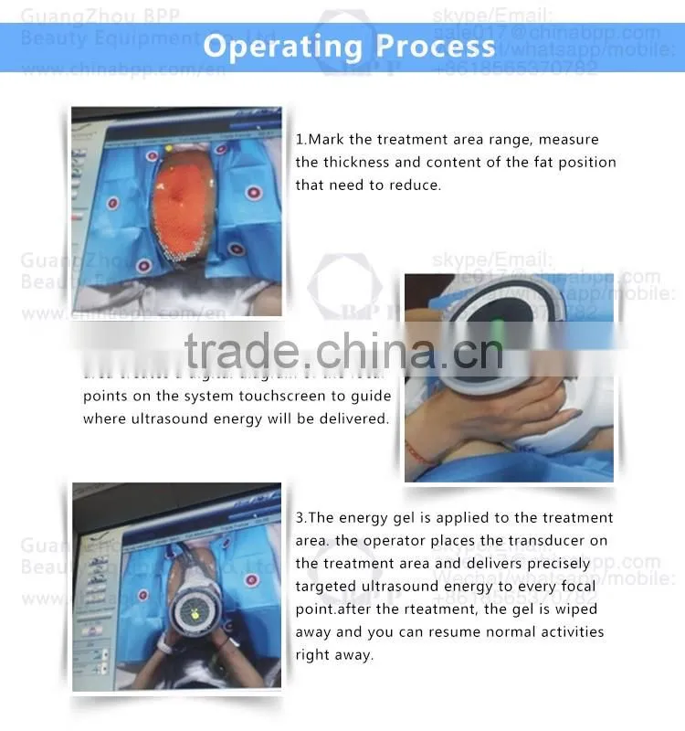 HIFU ultrashape best new slimming technology machine