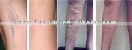 Protable soprano laser hair removal machine P003