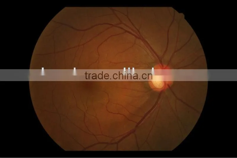 MCT-G/ High-end MCT Technology For Myopia with high intraocular pressure