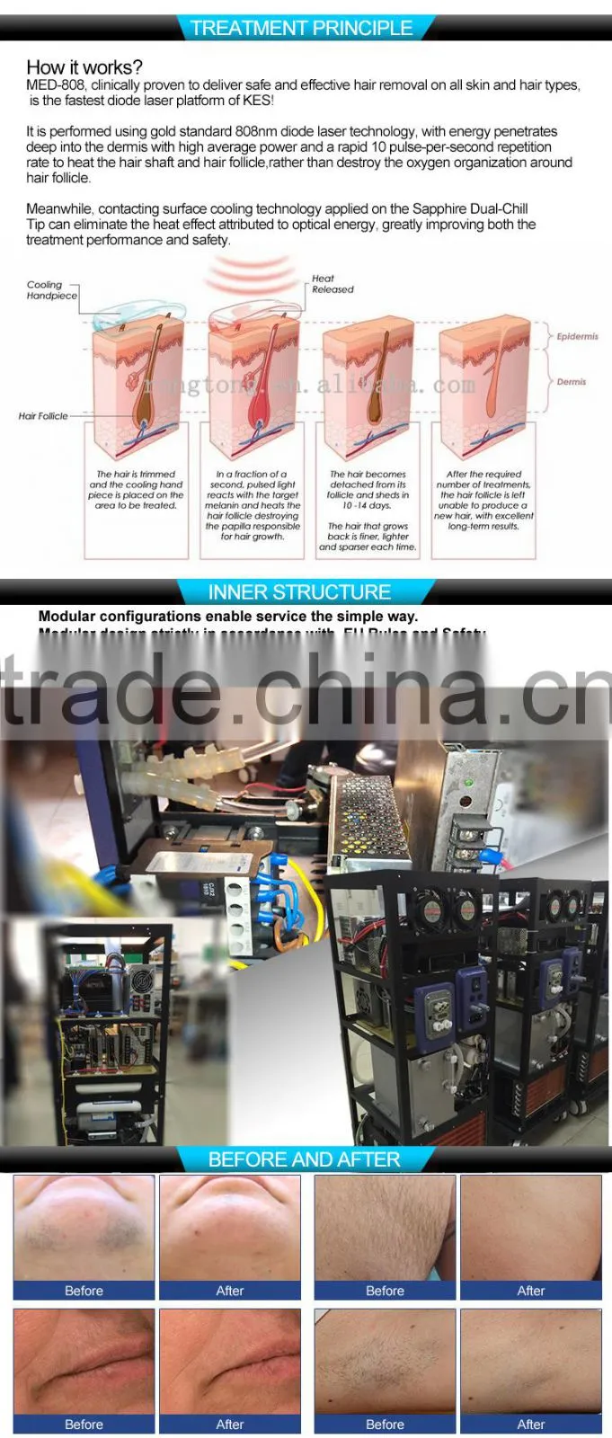 808nm painless hair removal permanent hair removal medial diode laser