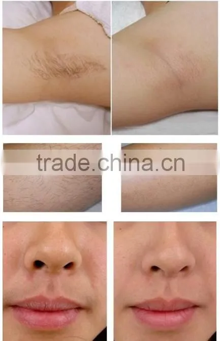 2016 beauty salon equipment diode laser hair removal epilator