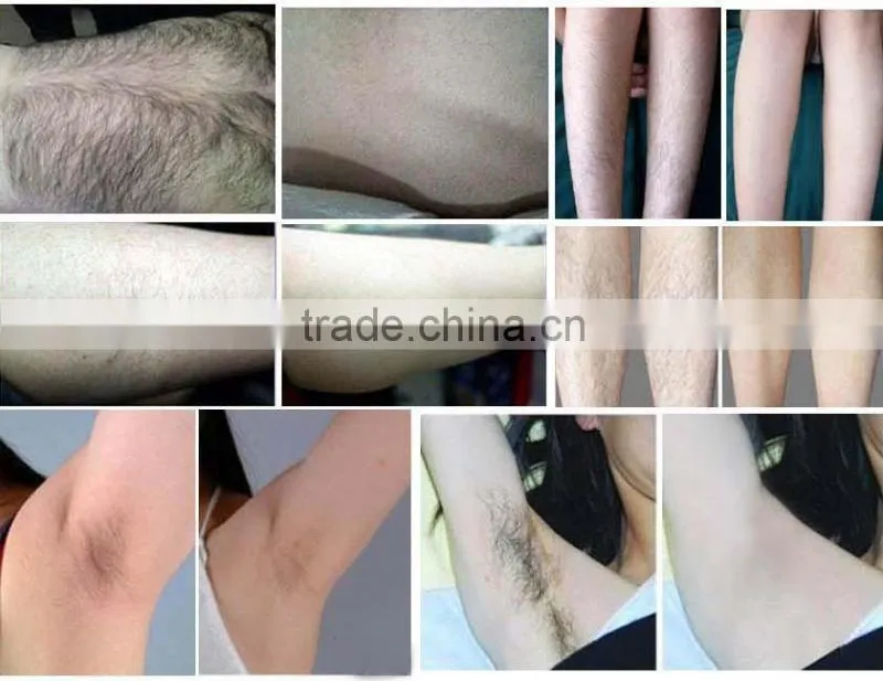 IPL Hair Removal Skin Rejuvenation Equipment/Beauty Salon IPL salon Machine