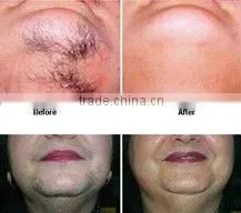 Salon equipment laser hair removal for sale