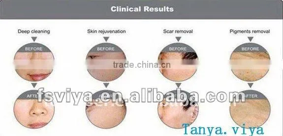 3 in 1 super Oxygen Peel Dermabrasion facial Machine