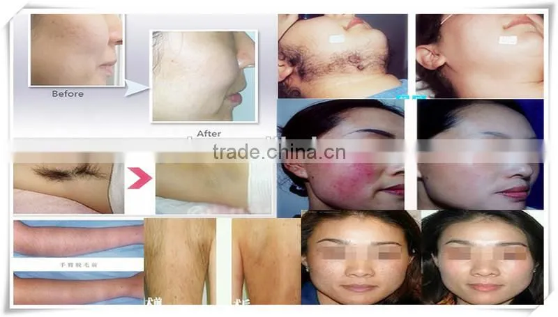 hot selling portable elight RF IPL body hair remover