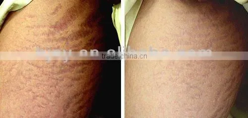 MNS derma roller microneedle derma roller mesotherapy derma roller