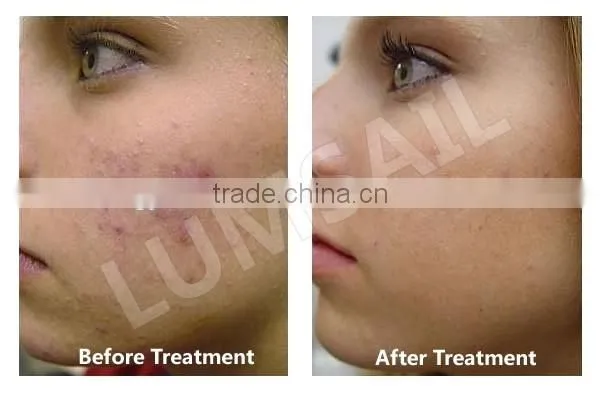 LED light therapy for anti-wrinkle /led phototherapy for skin rejuvenation skin tightening