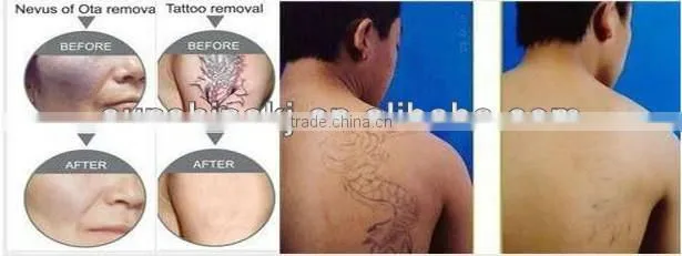 Hotselling nd yag laser remover tattoo with CE ISO certificate