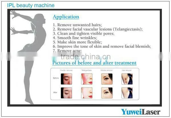 thread vein removal